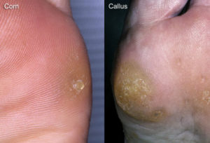 corn and callus