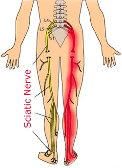 How does physiotherapy help sciatica?